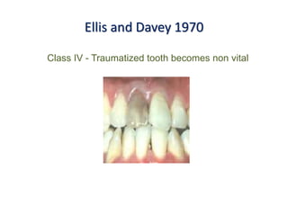 Ellis and Davey 1970
Class IV - Traumatized tooth becomes non vital
 