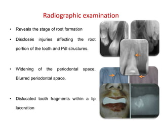 Radiographic examination
• Reveals the stage of root formation
• Discloses injuries affecting the root
portion of the tooth and Pdl structures.
• Widening of the periodontal space,
Blurred periodontal space.
• Dislocated tooth fragments within a lip
laceration
 