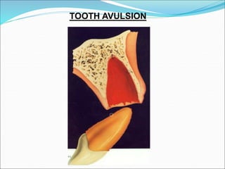 Tooth Avulsion Project TRAUMATIC INJURIES TO THE TEETH AND SUPPORTING STRUCTURES | PPT