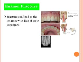 Infraction Tooth Traumatic injuries of teeth | PPT
