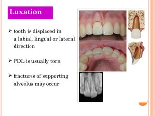 Luxation

 tooth is displaced in
  a labial, lingual or lateral
  direction

 PDL is usually torn

 fractures of suppor...