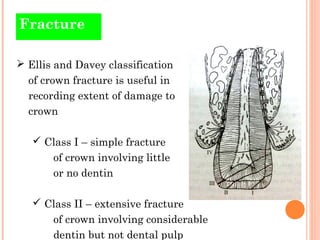 Fracture

 Ellis and Davey classification
  of crown fracture is useful in
  recording extent of damage to
  crown

    ...
