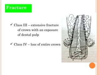 Fracture


  Class III – extensive fracture
     of crown with an exposure
     of dental pulp

  Class IV – loss of ent...