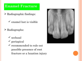 Tooth Microfracture Tooth Fracture Xray
