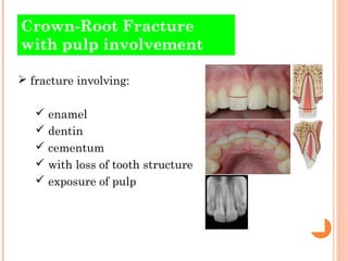 Crown-Root Fracture
with pulp involvement

 fracture involving:

    enamel
    dentin
    cementum
    with loss of ...