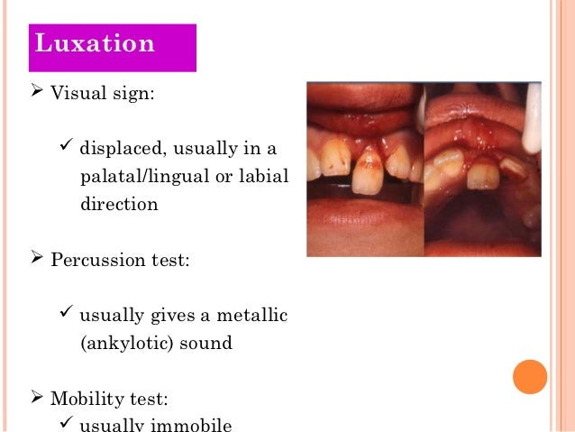 tooth luxation