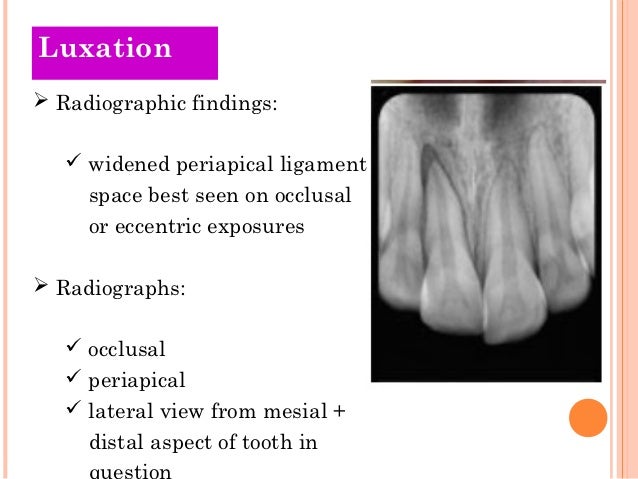 tooth luxation