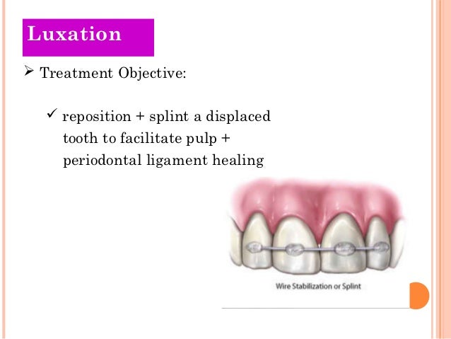 tooth luxation