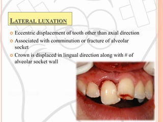 Traumatic injuries of teeth | PPTX