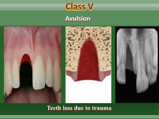 DR SHAKIR Traumatic injuries of teeth in children | PPTX
