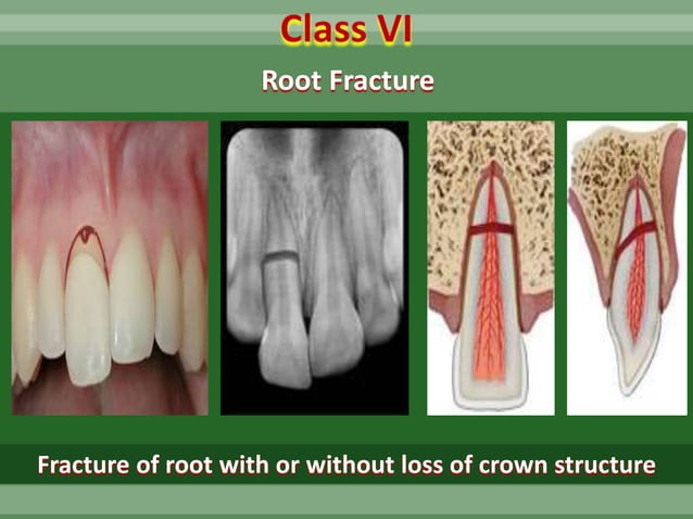 DR SHAKIR Traumatic injuries of teeth in children | PPT