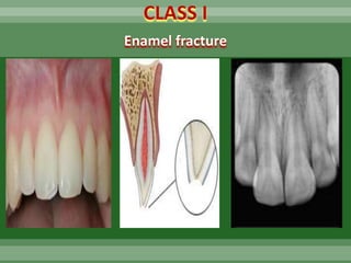 Enamel Infarctions DR SHAKIR Traumatic injuries of teeth in children | PPTX