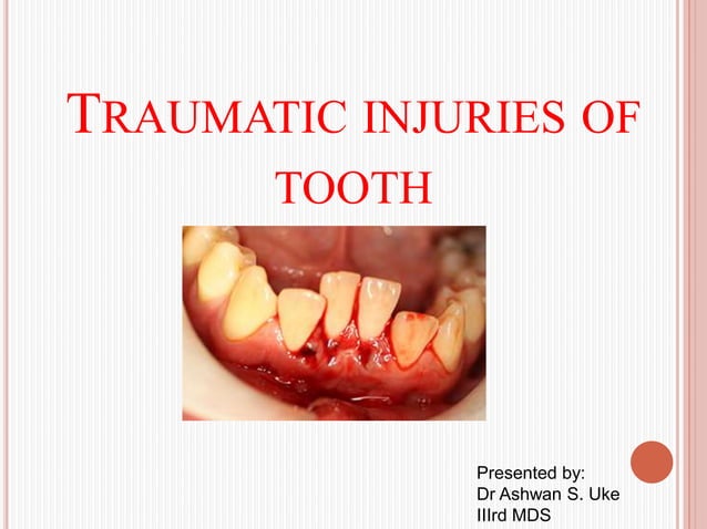 Traumatic Injuries to Teeth.pptx | Death, Injury, or Military Conflict ...
