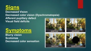 Signs
Decreased Vision
Decreased color vision (Dyschromatopsia)
Afferent pupillary defect
Visual field deficits
Symptoms
Blurry vision
Scotomas
Decreased color sensation
 
