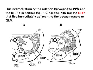 Pps Radiopaedia Traumatic Retroperitoneal Hematoma | PPTX