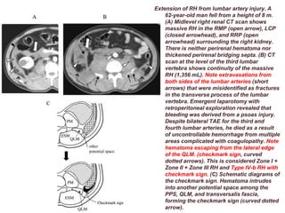 Traumatic Reticuloperitonitis Rads Traumatic Retroperitoneal Hematoma | PPTX