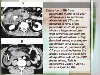Extension of RH from pelvic fracture.
A 63-year-old man was hit by a
dump truck. (A) CT scan at level of
the anterior supe...