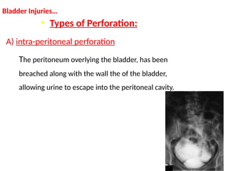 Perforation Injuries Traumatic Urological Emergencies - Differential Diagnosis | PPTX