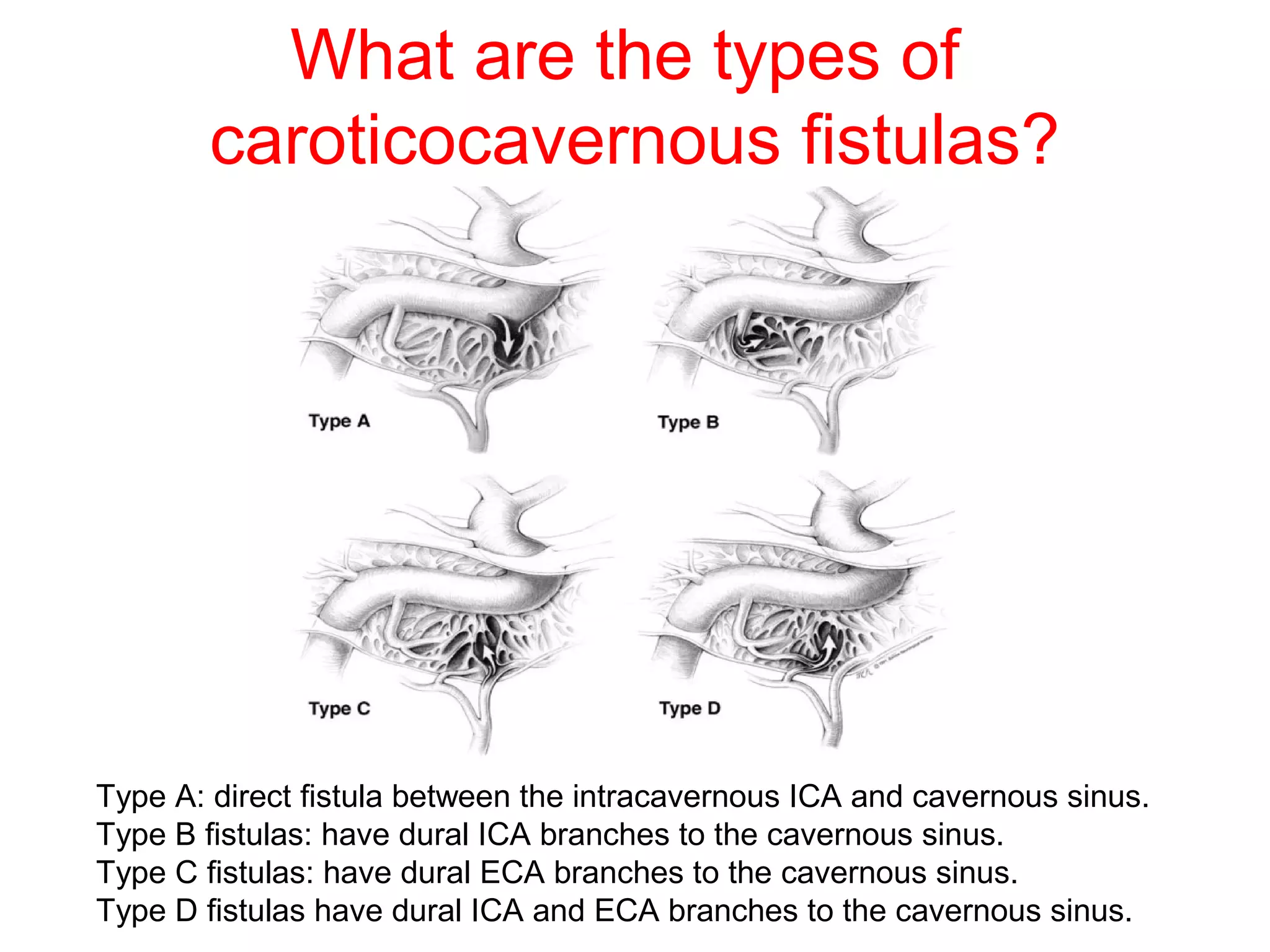 Traumatic vascular injuries of brain | PPT