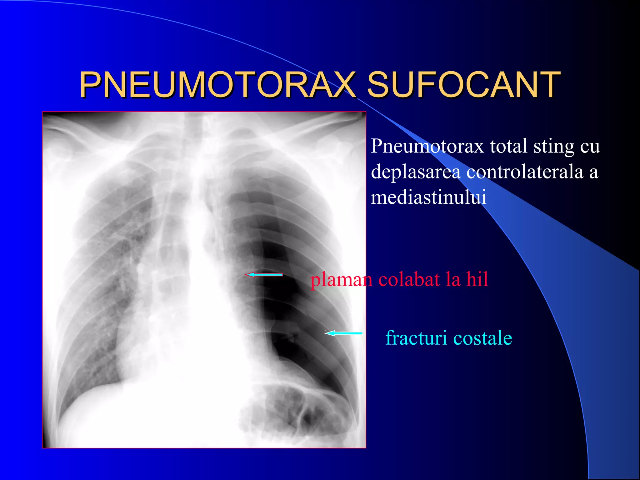 PNEUMOTORAX SUFOCANTPNEUMOTORAX SUFOCANT
 Pneumotorax total sting cu
deplasarea controlaterala a
mediastinului
fracturi costale
plaman colabat la hil
 
