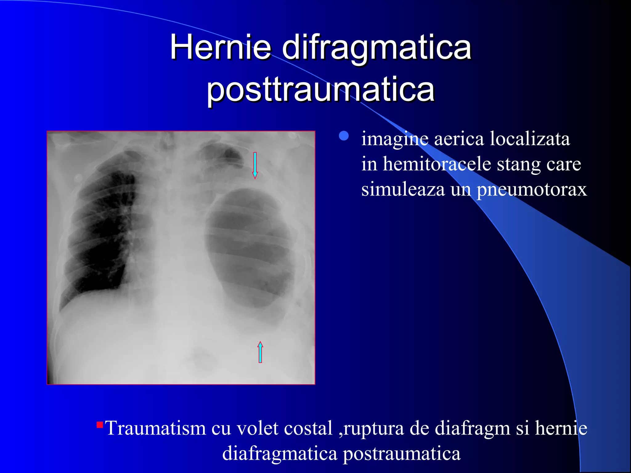 Hernie difragmaticaHernie difragmatica
posttraumaticaposttraumatica
Traumatism cu volet costal ,ruptura de diafragm si hernie
diafragmatica postraumatica
 imagine aerica localizata
in hemitoracele stang care
simuleaza un pneumotorax
 