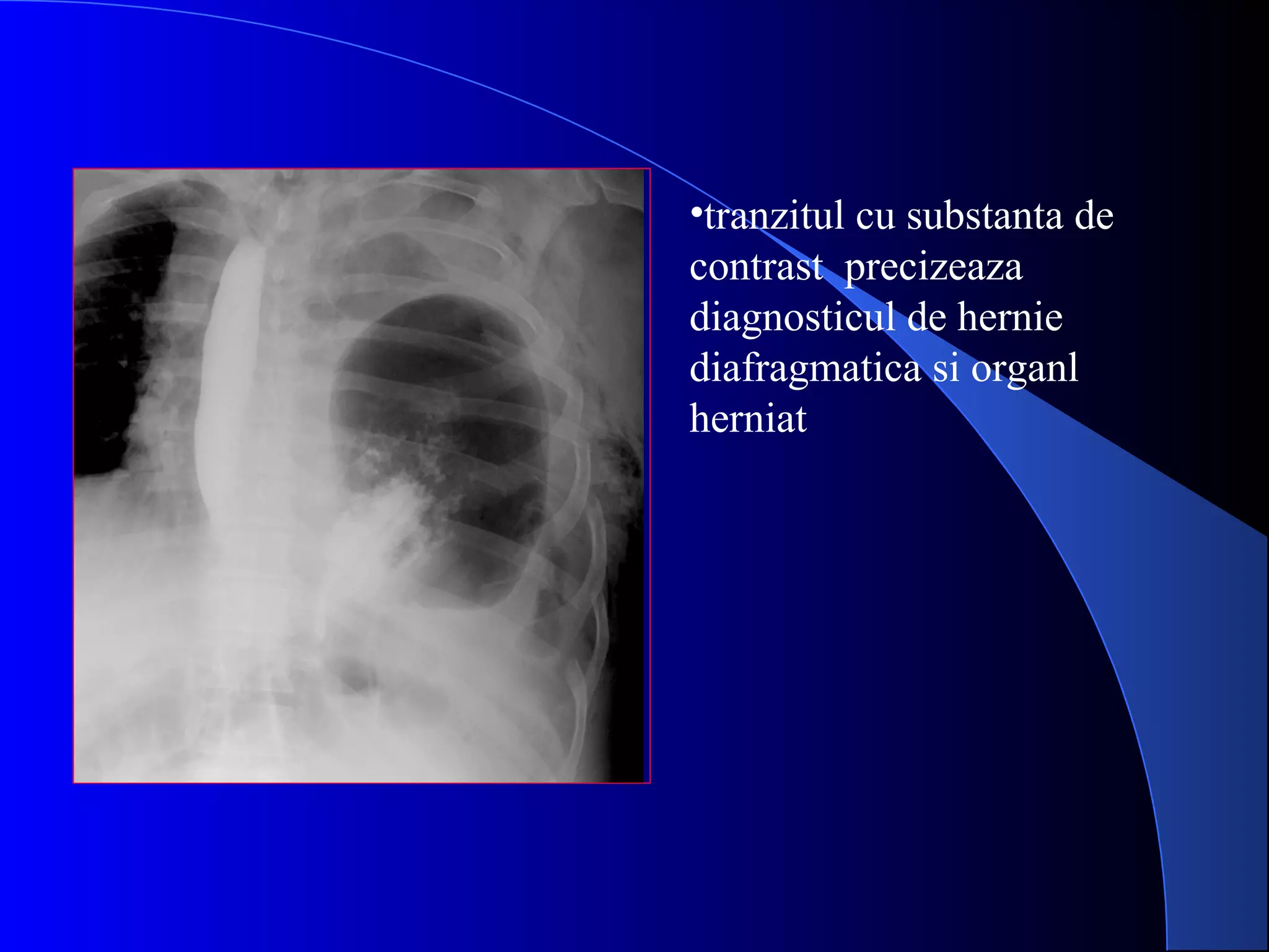 •tranzitul cu substanta de
contrast precizeaza
diagnosticul de hernie
diafragmatica si organl
herniat
 