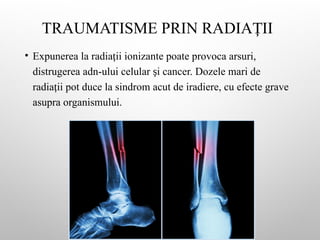 TRAUMATISME PRIN RADIA II
Ț
• Expunerea la radia ii ionizante poate provoca arsuri,
ț
distrugerea adn-ului celular i cancer. Dozele mari de
ș
radia ii pot duce la sindrom acut de iradiere, cu efecte grave
ț
asupra organismului.
 
