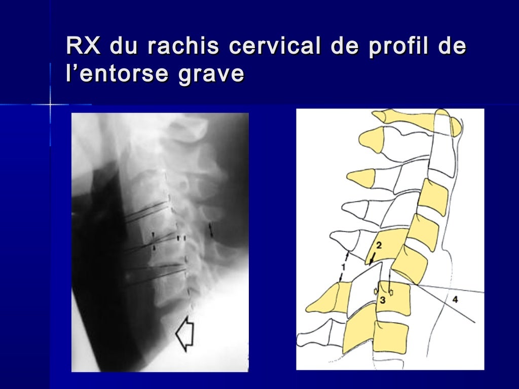 Traumatismes du rachis cervical 2