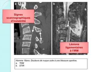 Homme 16ans. Douleurs de nuque suite à une blessure sportive.
a. TDM
b. STIR
Signes
scannographiques
d’instabilité
Lésions
ligamentaires
à l’IRM
 