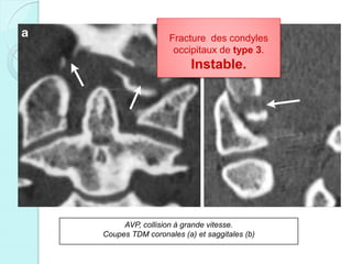 AVP, collision à grande vitesse.
Coupes TDM coronales (a) et saggitales (b)
Fracture des condyles
occipitaux de type 3.
Instable.
 