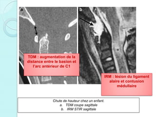 Chute de hauteur chez un enfant.
a. TDM coupe sagittale
b. IRM STIR sagittale
TDM : augmentation de la
distance entre le basion et
l’arc antérieur de C1
IRM : lésion du ligament
alaire et contusion
médullaire
 