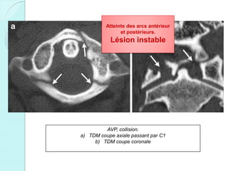 AVP, collision.
a) TDM coupe axiale passant par C1
b) TDM coupe coronale
Atteinte des arcs antérieur
et postérieurs.
Lésion instable
 