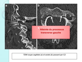 TDM coupe sagittale (a) et axiale (b) passant par C2
Déplacement minime.
Lésion stable
* Atteinte du processus
transverse gauche
 
