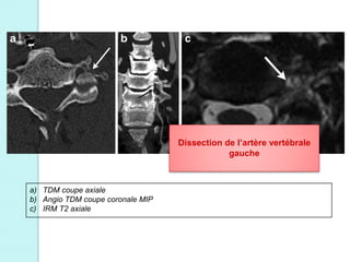 a) TDM coupe axiale
b) Angio TDM coupe coronale MIP
c) IRM T2 axiale
Dissection de l’artère vertébrale
gauche
 