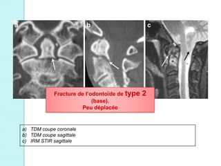 a) TDM coupe coronale
b) TDM coupe sagittale
c) IRM STIR sagittale
Fracture de l’odontoïde de type 2
(base).
Peu déplacée
 
