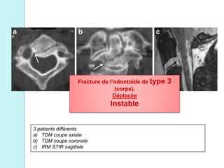3 patients différents
a) TDM coupe axiale
b) TDM coupe coronale
c) IRM STIR sagittale
Fracture de l’odontoïde de type 3
(corps).
Déplacée
Instable
 