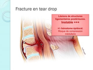 Fracture en tear drop
Lésions de structures
ligamentaires postérieures.
Instable +++
+/- hématome épidural.
Risque de compression
médullaire
 