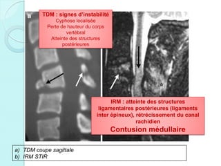 a) TDM coupe sagittale
b) IRM STIR
TDM : signes d’instabilité
Cyphose localisée
Perte de hauteur du corps
vertébral
Atteinte des structures
postérieures
IRM : atteinte des structures
ligamentaires postérieures (ligaments
inter épineux), rétrécissement du canal
rachidien
Contusion médullaire
 