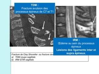 Fracture de Clay Shoveller ou fracture des terrassiers
a) TDM coupe sagittale
b) IRM STIR sagittale
TDM :
Fracture avulsion des
processus épineux de C7 et T1
IRM :
Œdème au sein du processus
épineux
Lésions des ligaments inter et
supra épineux.
 