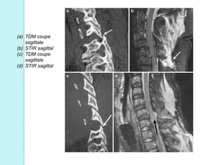(a) TDM coupe
sagittale
(b) STIR sagittal
(c) TDM coupe
sagittale
(d) STIR sagittal
 