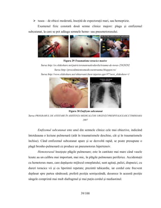 39/100
 tusea – de obicei moderată, însoţită de expectoraţii mari, sau hemoptizie.
Examenul fizic constată două semne clinice majore: plaga şi emfizemul
subcutanat, la care se pot adăuga semnele hemo- sau pneumotoraxului.
Figura 29 Traumatisme toracice masive
Sursa:http://es.slideshare.net/patriciorenanrualesdavila/trauma-de-torax-25820292
Sursa:http://procedimientosmedicosentrauma.blogspot.ro/
Sursa:http://www.slideshare.net/whtarrant/chest-injuries-ppt-97?next_slideshow=1
Figura 30 Emfizem subcutanat
Sursa:PROGRAMUL DE ATESTARE ÎN ASISTENŢA MEDICALĂ DE URGENŢĂ PRESPITALICEASCĂ TIMISOARA
2007
Emfizemul subcutanat este unul din semnele clinice cele mai obiective, indicând
întotdeauna o leziune pulmonară (atât în traumatismele deschise, cât şi în traumatismele
închise). Când emfizemul subcutanat apare şi se dezvoltă rapid, se poate presupune o
plagă bronho-pulmonară ce produce un pneumotorax hipertensiv.
Hemotoraxul însoţeşte plăgile pulmonare; este în cantitate mai mare când vasele
lezate au un calibru mai important, mai mic, în plăgile pulmonare periferice. Accidentaţii
cu hemotorax mare, care depăşeste mijlocul omoplatului, sunt agitaţi, palizi, dispneici, cu
dureri toracice vii şi cu lipotimii repetate; prezintă tahicardie, iar cordul este frecvent
deplasat spre partea sănătoasă; preferă poziţia semişezândă, deoarece în această poziţie
sângele comprimă mai mult diafragmul şi mai puţin cordul şi mediastinul.
 