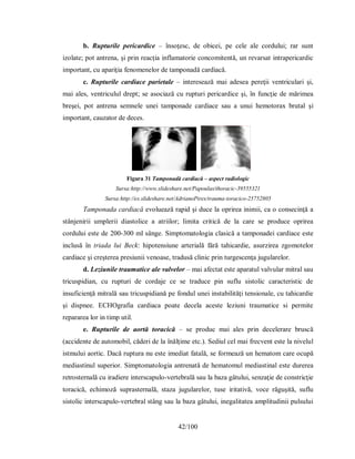 42/100
b. Rupturile pericardice – însoţesc, de obicei, pe cele ale cordului; rar sunt
izolate; pot antrena, şi prin reacţia inflamatorie concomitentă, un revarsat intrapericardic
important, cu apariţia fenomenelor de tamponadă cardiacă.
c. Rupturile cardiace parietale – interesează mai adesea pereţii ventriculari şi,
mai ales, ventriculul drept; se asociază cu rupturi pericardice şi, în funcţie de mărimea
breşei, pot antrena semnele unei tamponade cardiace sau a unui hemotorax brutal şi
important, cauzator de deces.
Figura 31 Tamponadă cardiacă – aspect radiologic
Sursa:http://www.slideshare.net/Papoulas/thoracic-39555321
Sursa:http://es.slideshare.net/AdrianoPires/trauma-toracico-25752805
Tamponada cardiacă evoluează rapid şi duce la oprirea inimii, ca o consecinţă a
stânjenirii umplerii diastolice a atriilor; limita critică de la care se produce oprirea
cordului este de 200-300 ml sânge. Simptomatologia clasică a tamponadei cardiace este
inclusă în triada lui Beck: hipotensiune arterială fără tahicardie, asurzirea zgomotelor
cardiace şi creşterea presiunii venoase, tradusă clinic prin turgescenţa jugularelor.
d. Leziunile traumatice ale valvelor – mai afectat este aparatul valvular mitral sau
tricuspidian, cu rupturi de cordaje ce se traduce pin suflu sistolic caracteristic de
insuficienţă mitrală sau tricuspidiană pe fondul unei instabilităţi tensionale, cu tahicardie
şi dispnee. ECHOgrafia cardiaca poate decela aceste leziuni traumatice si permite
repararea lor in timp util.
e. Rupturile de aortă toracică – se produc mai ales prin decelerare bruscă
(accidente de automobil, căderi de la înălţime etc.). Sediul cel mai frecvent este la nivelul
istmului aortic. Dacă ruptura nu este imediat fatală, se formează un hematom care ocupă
mediastinul superior. Simptomatologia antrenată de hematomul mediastinal este durerea
retrosternală cu iradiere interscapulo-vertebrală sau la baza gâtului, senzaţie de constricţie
toracică, echimoză suprasternală, staza jugularelor, tuse iritativă, voce răguşită, suflu
sistolic interscapulo-vertebral stâng sau la baza gâtului, inegalitatea amplitudinii pulsului
 