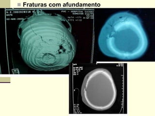  Fraturas com afundamento
 