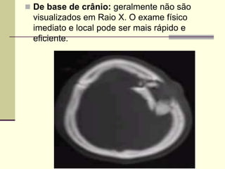  De base de crânio: geralmente não são
visualizados em Raio X. O exame físico
imediato e local pode ser mais rápido e
eficiente.
 