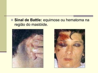  Sinal de Battle: equimose ou hematoma na
região do mastóide.
 