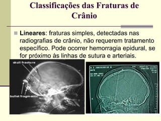 Classificações das Fraturas de
Crânio
 Lineares: fraturas simples, detectadas nas
radiografias de crânio, não requerem tratamento
específico. Pode ocorrer hemorragia epidural, se
for próximo às linhas de sutura e arteriais.
 