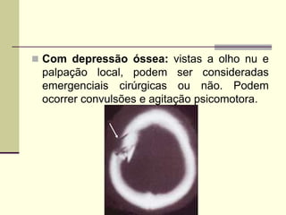  Com depressão óssea: vistas a olho nu e
palpação local, podem ser consideradas
emergenciais cirúrgicas ou não. Podem
ocorrer convulsões e agitação psicomotora.
 