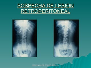 SOSPECHA DE LESION RETROPERITONEAL 