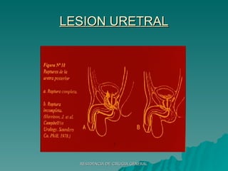 LESION URETRAL 