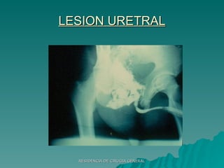 LESION URETRAL 